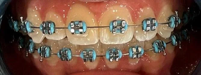 Braces treatment progress after orthodontic consultation in the UAE