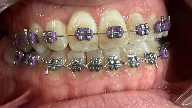 Active orthodontic treatment and braces stage following specialist consult